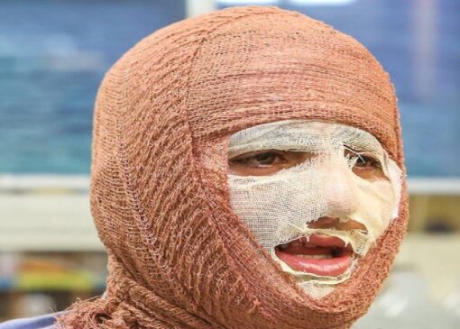 سوختگی؛ آسیب جسمی و روانی که فراتر از درمان است