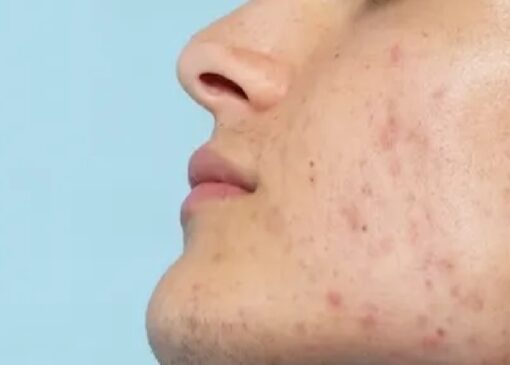 قوی‌ترین نسخه طب سنتی برای مقابله با آکنه صورت + فیلم