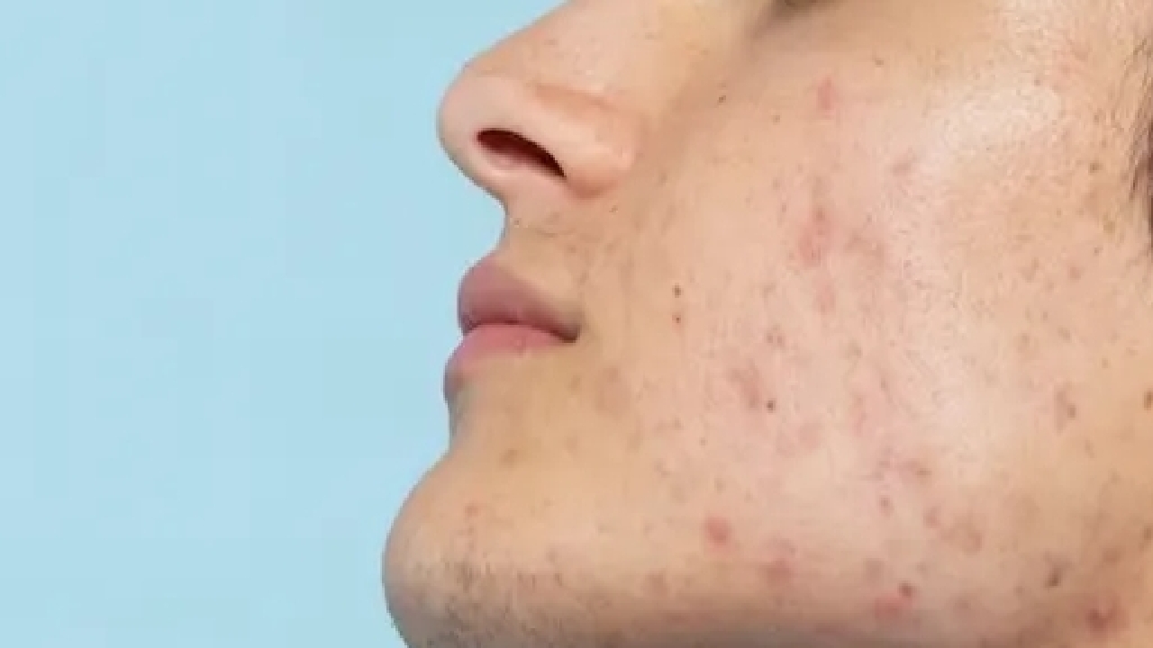 قوی‌ترین نسخه طب سنتی برای مقابله با آکنه صورت + فیلم