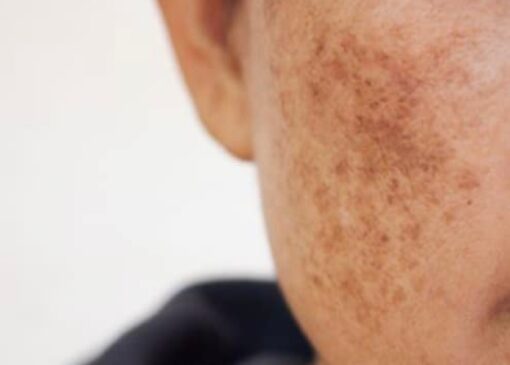 آلودگی هوا و پوست؛ چگونه از التهاب و خطر سرطان پیشگیری کنیم؟