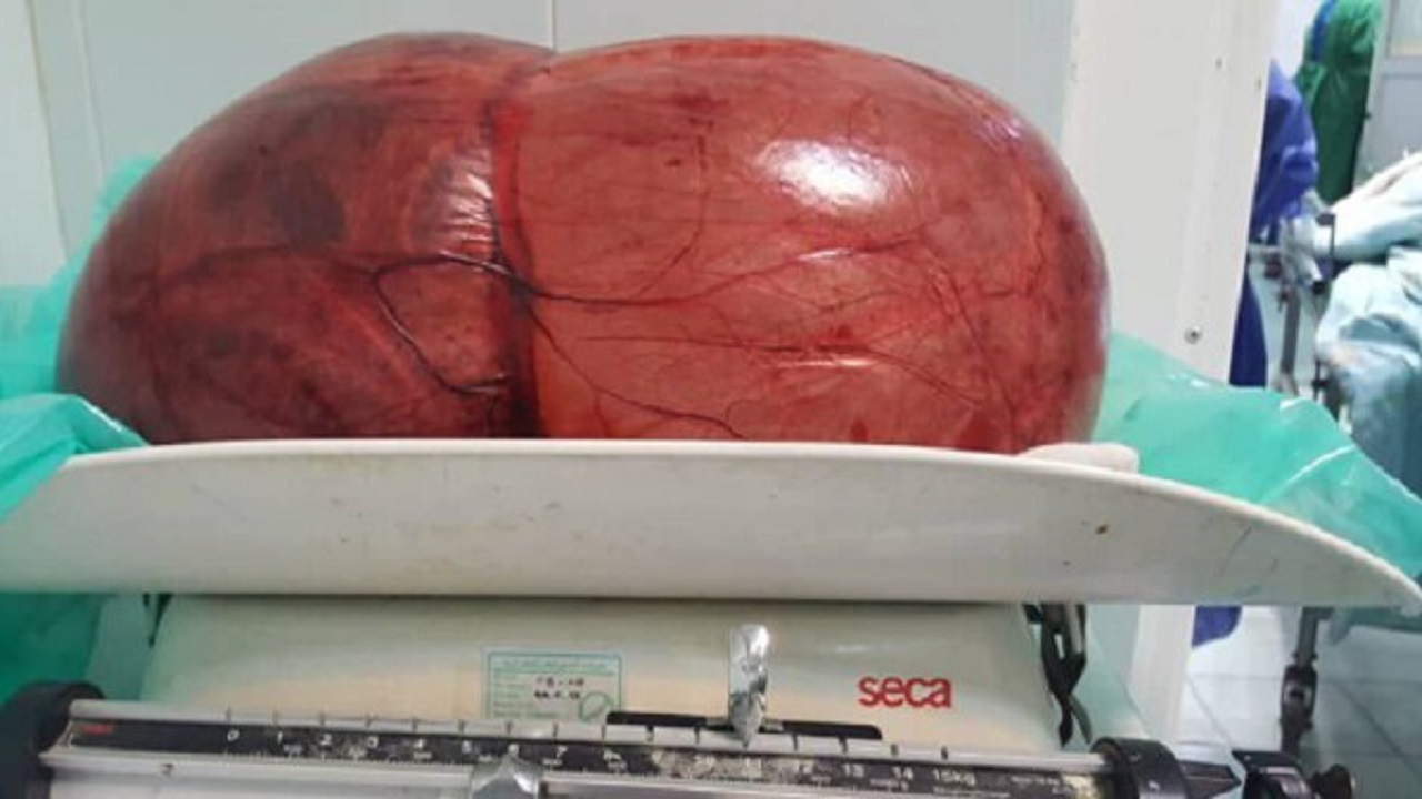 برداشتن توده ۲ کیلویی از شکم خانمی ۴۲ ساله