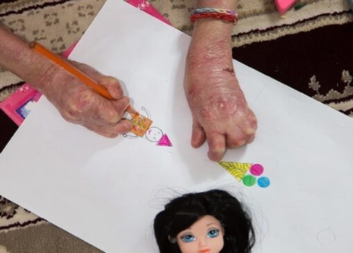 بنیاد امور بیماری‌های خاص به مطالبات بیماران پروانه‌ای پاسخی نمی دهد