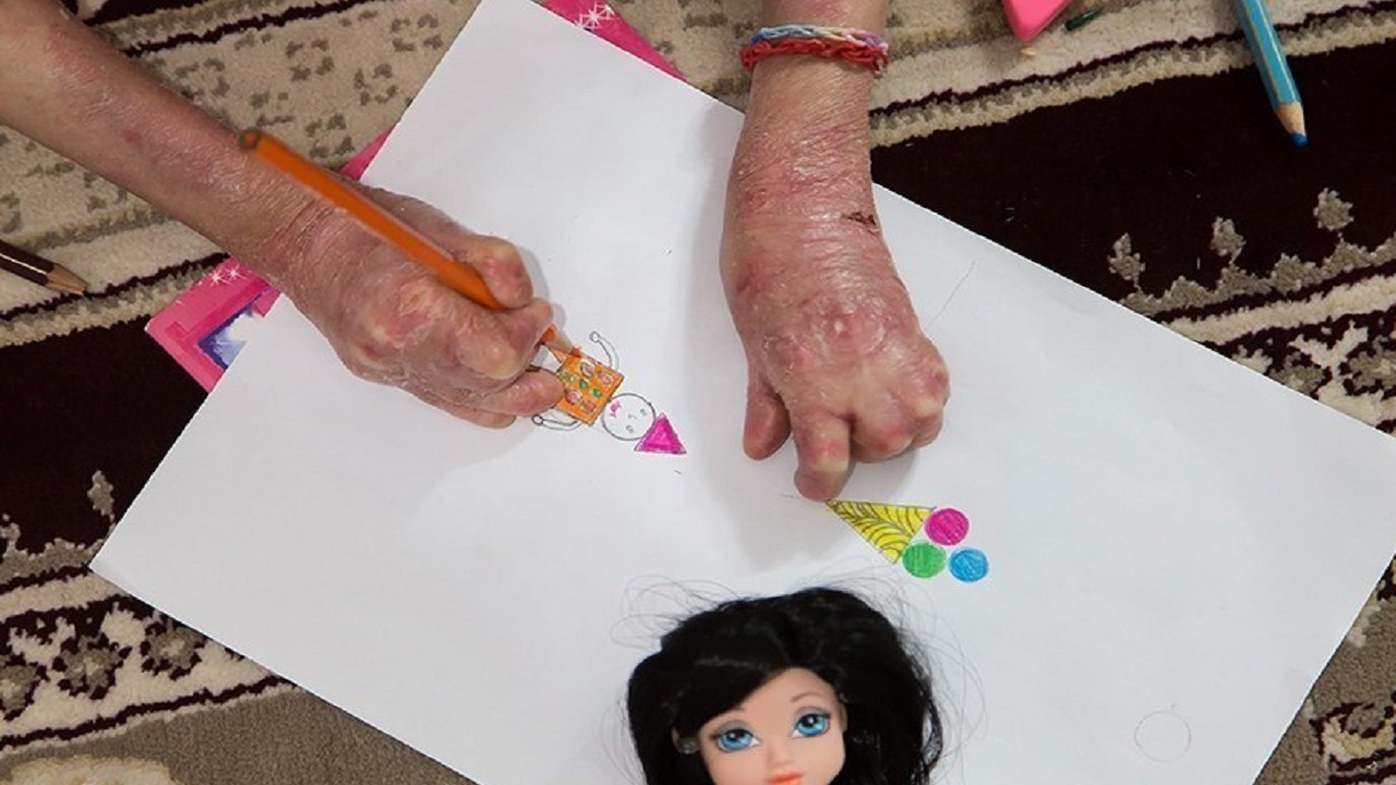 بنیاد امور بیماری‌های خاص به مطالبات بیماران پروانه‌ای پاسخی نمی دهد