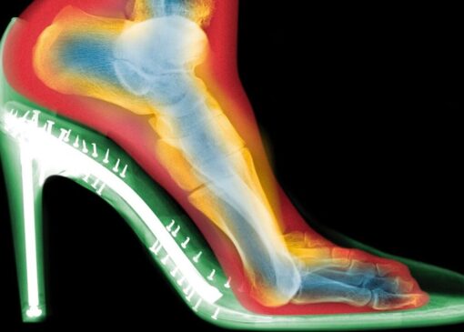 بلایی که پاشنه‌بلند سرتان می‌آورد: از «قوز شست» تا «انگشتان چنگالی»