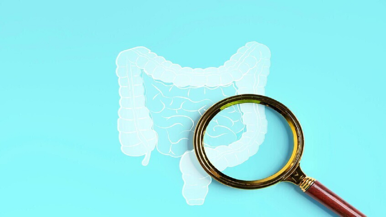 کشف ارتباط بین دارو‌های کلسترول و کاهش احتمال سرطان روده بزرگ